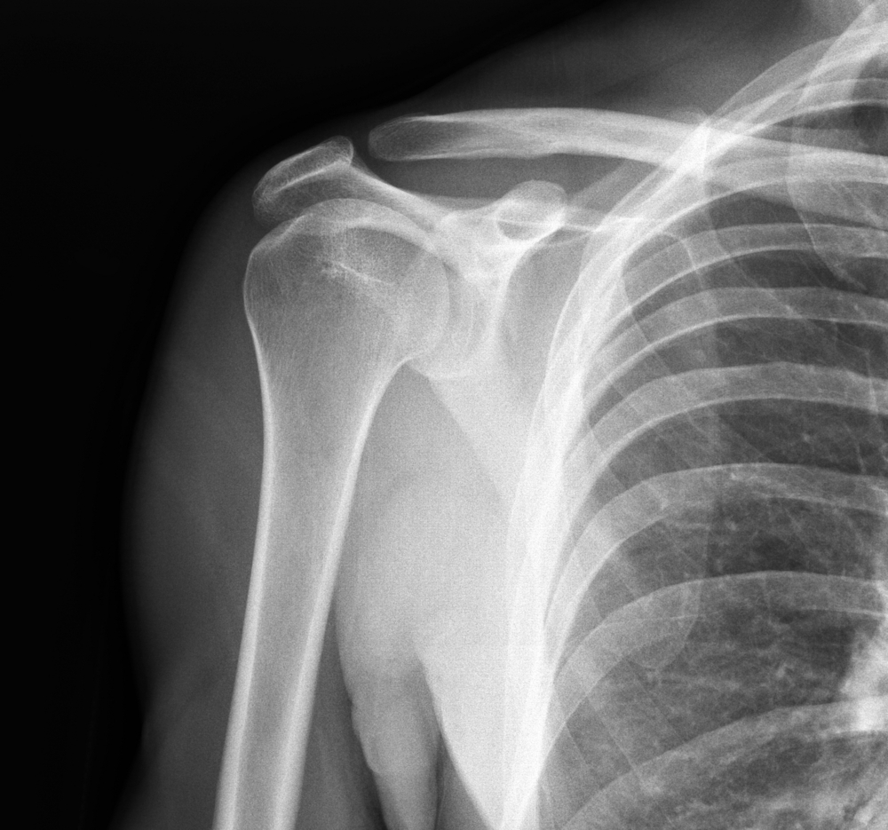 Radiographie d'une épaule